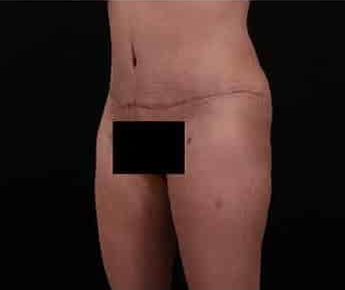 After Image: Tummy Tuck (Abdominoplasty) - left-front-oblique