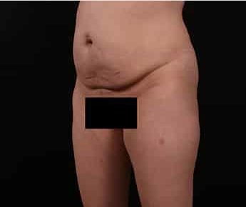 Before Image: Tummy Tuck (Abdominoplasty) - left-front-oblique