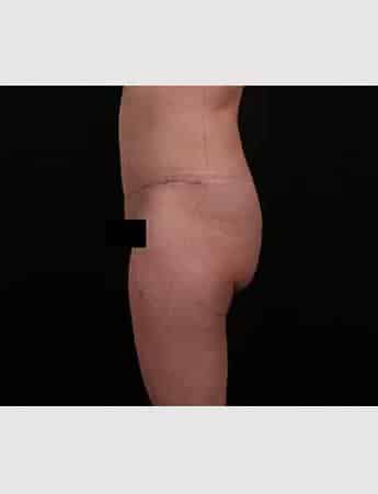 After Image: Tummy Tuck (Abdominoplasty) - left-side