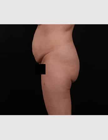 Before Image: Tummy Tuck (Abdominoplasty) - left-side