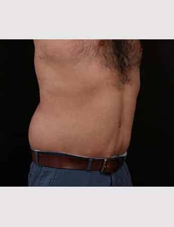 After Image: Belt Lipectomy - right-front-oblique