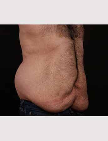 Before Image: Belt Lipectomy - right-front-oblique