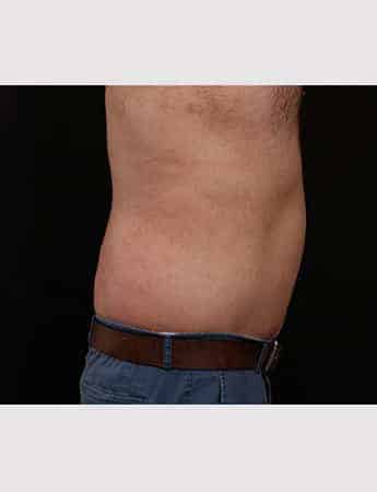 After Image: Belt Lipectomy - right-side