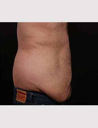 Before Image: Belt Lipectomy - right-side