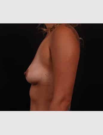 Before Image: Breast Augmentation - left-side