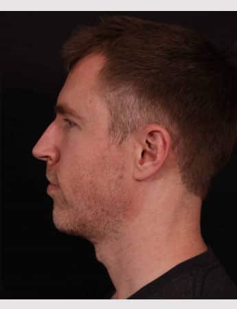 After Image: Neck Lift & Chin Implant - left-side