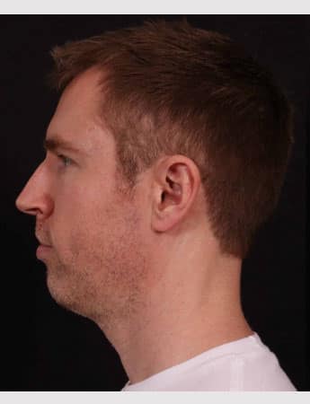 Before Image: Neck Lift & Chin Implant - left-side