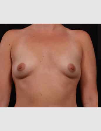 Before Image: Breast Augmentation - front
