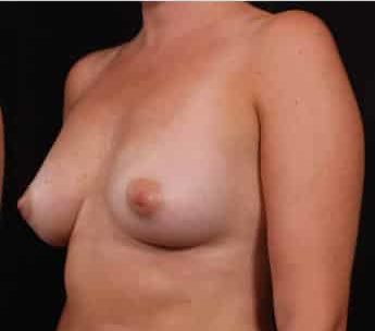 After Image: Breast Augmentation - left-front-oblique