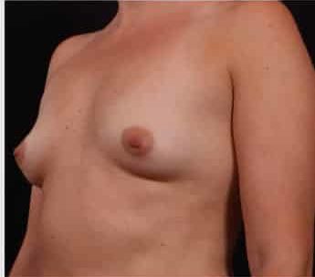 Before Image: Breast Augmentation - left-front-oblique
