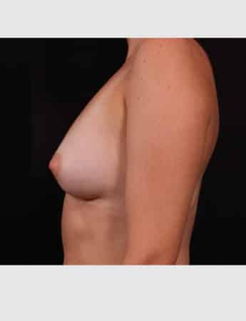 After Image: Breast Augmentation - left-side
