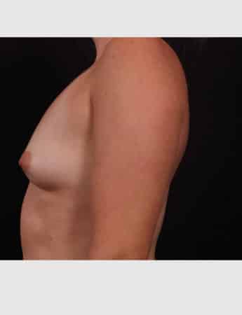 Before Image: Breast Augmentation - left-side