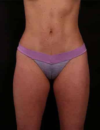 After Image: Mini Tummy Tuck (Mini Abdominopalsty) - front