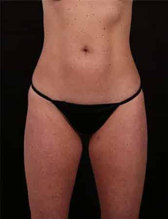 Before Image: Mini Tummy Tuck (Mini Abdominopalsty) - front