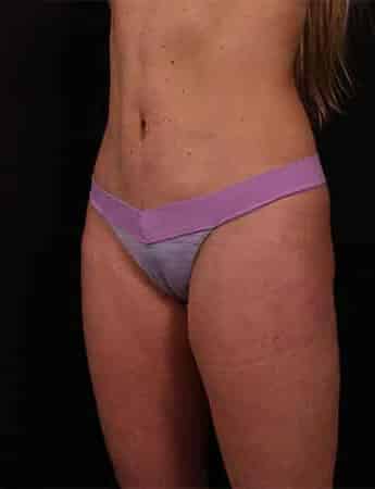 After Image: Mini Tummy Tuck (Mini Abdominopalsty) - left-front-oblique
