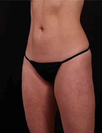 Before Image: Mini Tummy Tuck (Mini Abdominopalsty) - left-front-oblique