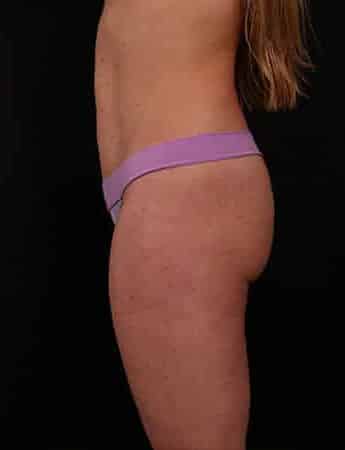 After Image: Mini Tummy Tuck (Mini Abdominopalsty) - left-side