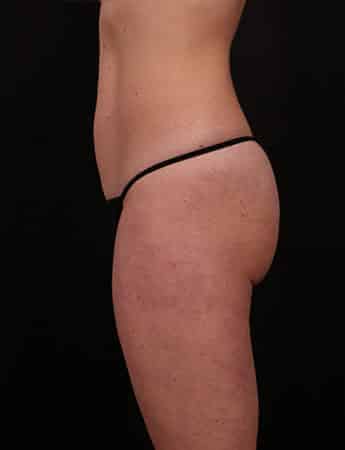 Before Image: Mini Tummy Tuck (Mini Abdominopalsty) - left-side