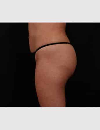 After Image: Brazilian Butt Lift - left-side