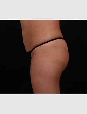 Before Image: Brazilian Butt Lift - left-side