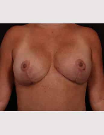 After Image: Mastopexy (Breast Lift) - front
