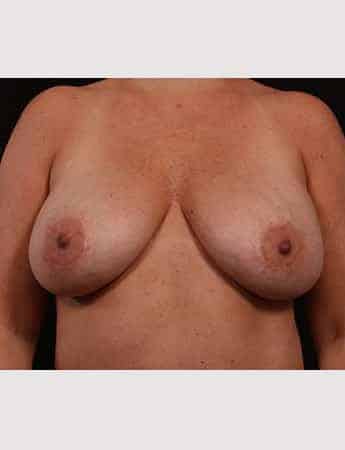 Before Image: Mastopexy (Breast Lift) - front