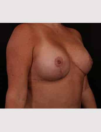 After Image: Mastopexy (Breast Lift) - right-front-oblique