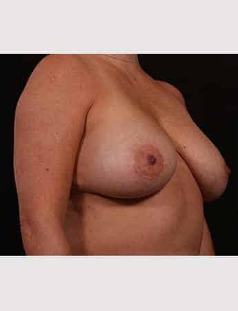 Before Image: Mastopexy (Breast Lift) - right-front-oblique