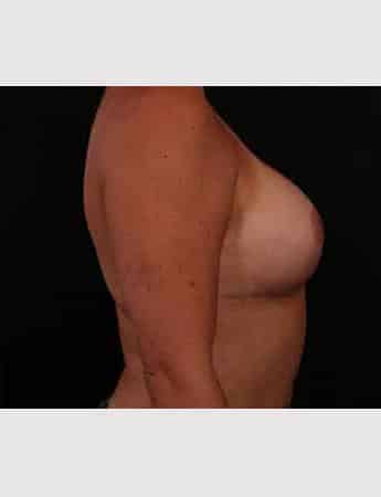 After Image: Mastopexy (Breast Lift) - right-side
