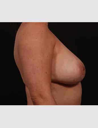 Before Image: Mastopexy (Breast Lift) - right-side