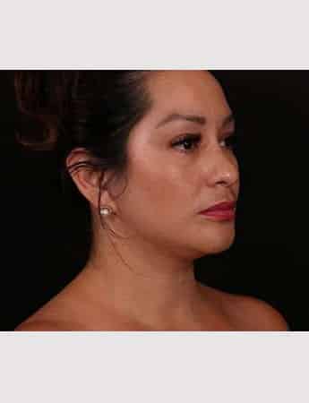 After Image: Female Neck Lift / Lower Facelift - right-front-oblique