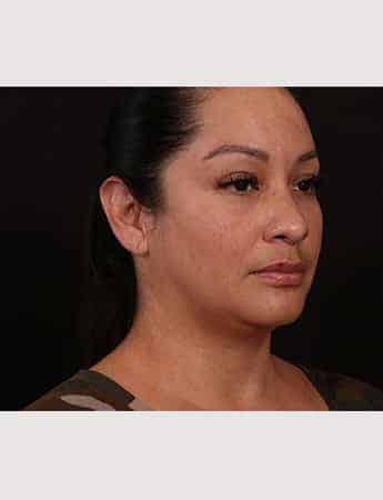 Before Image: Female Neck Lift / Lower Facelift - right-front-oblique