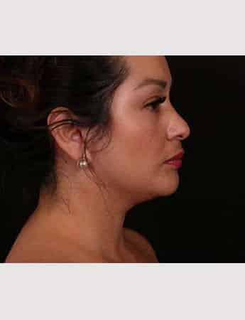 After Image: Female Neck Lift / Lower Facelift - right-side