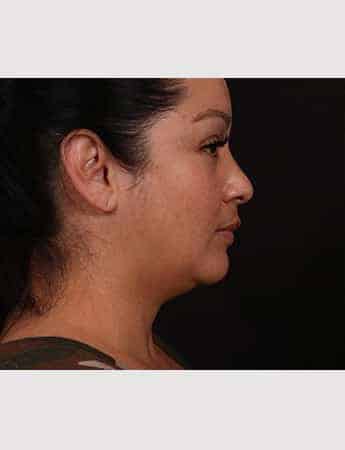 Before Image: Female Neck Lift / Lower Facelift - right-side