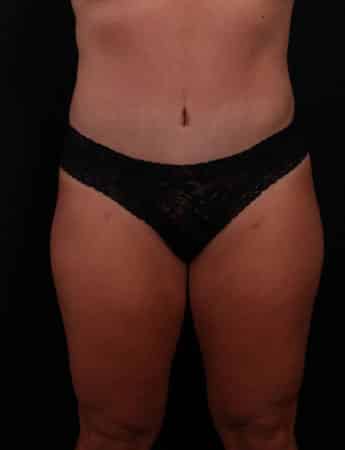 After Image: Tummy Tuck (Abdominoplasty) - front