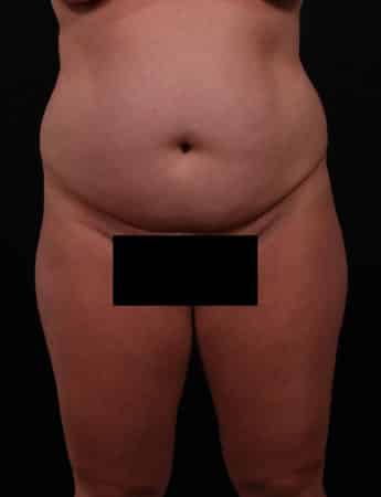 Before Image: Tummy Tuck (Abdominoplasty) - front