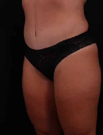 After Image: Tummy Tuck (Abdominoplasty) - left-front-oblique