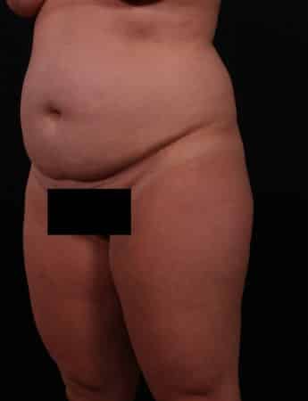 Before Image: Tummy Tuck (Abdominoplasty) - left-front-oblique