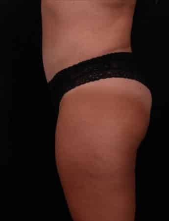 After Image: Tummy Tuck (Abdominoplasty) - left-side