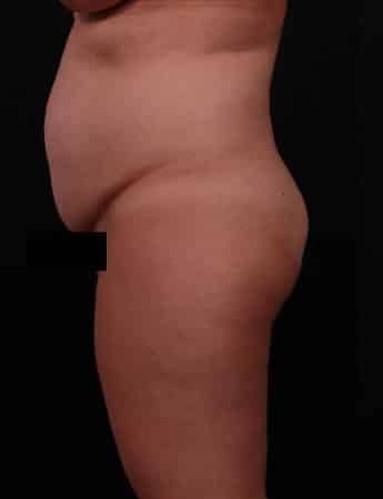 Before Image: Tummy Tuck (Abdominoplasty) - left-side
