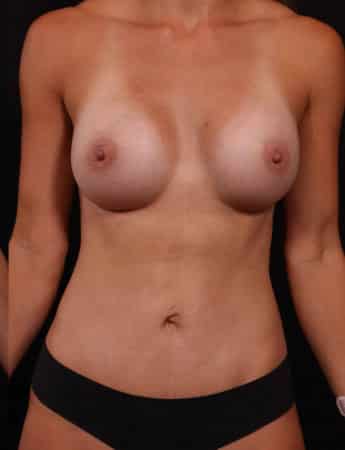 After Image: Mommy Makeover - front
