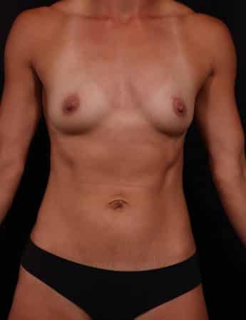 Before Image: Mommy Makeover - front