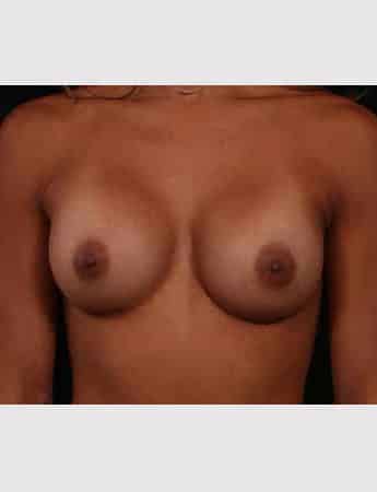 After Image: Breast Augmentation - front