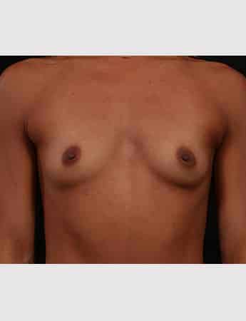 Before Image: Breast Augmentation - front