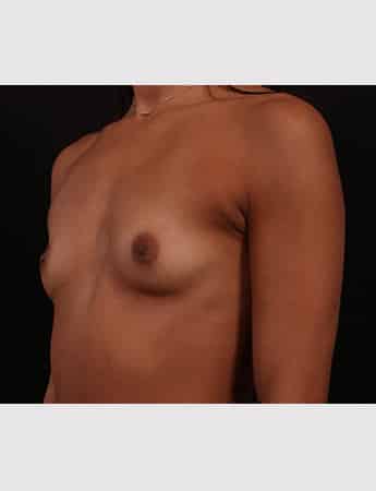 Before Image: Breast Augmentation - left-front-oblique