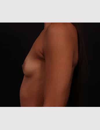Before Image: Breast Augmentation - left-side