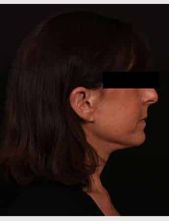 After Image: Face Lift - right-side