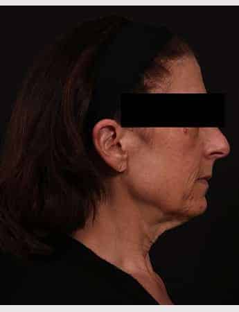 Before Image: Face Lift - right-side