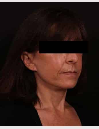 After Image: Face Lift - right-front-oblique