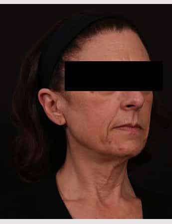 Before Image: Face Lift - right-front-oblique
